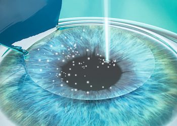 Ketergantungan Kacamata Minus? Saatnya Coba LASIK